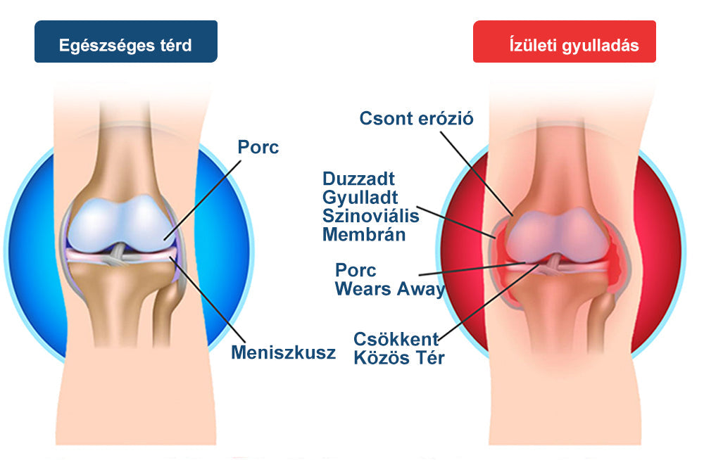 ArthroFree™ 🐝Gydomasis artrito kremas su bičių nuodais ir ciberžole - specialiai sukurtas gydyti ortopedines ligas ir sąnarių skausmus 🍀