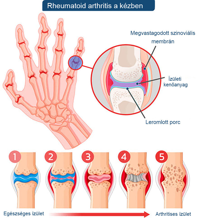 ArthroFree™ 🐝Gydomasis artrito kremas su bičių nuodais ir ciberžole - specialiai sukurtas gydyti ortopedines ligas ir sąnarių skausmus 🍀