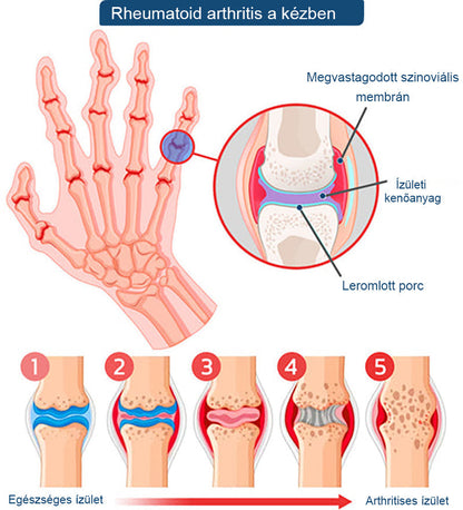 ArthroFree™ 🐝Gydomasis artrito kremas su bičių nuodais ir ciberžole - specialiai sukurtas gydyti ortopedines ligas ir sąnarių skausmus 🍀